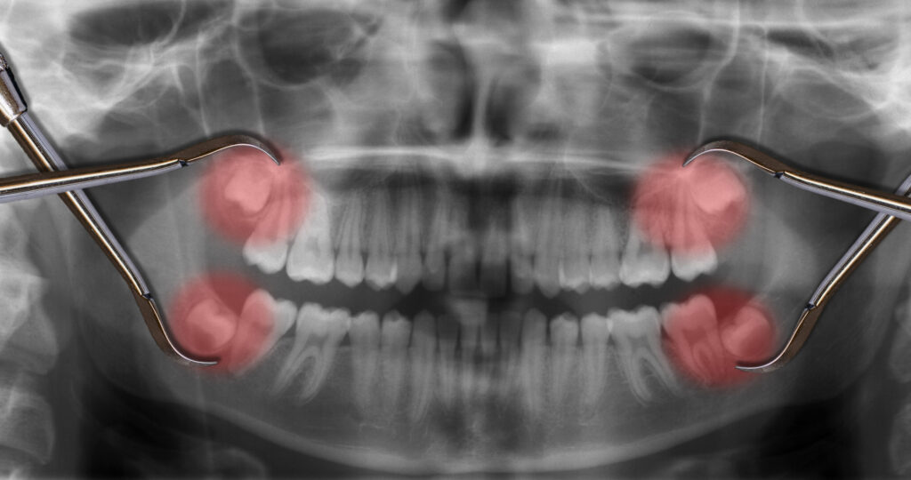 x ray of wisdom teeth needing removal