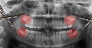 x ray of wisdom teeth needing removal